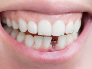 Dental Implant Surgery